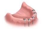 arch with implants installed