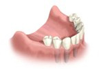 arch with teeth installed