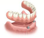 removable overdenture arch
