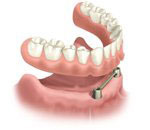removable overdenture arch implant anchored