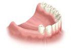 arch with missing teeth - before procedure