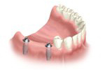 arch with multi-implant installed