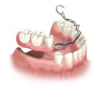 partial removable denture arch